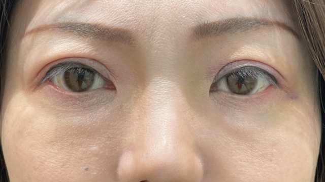 手術前の状態 その1