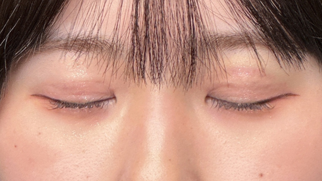 手术前的状态 其一