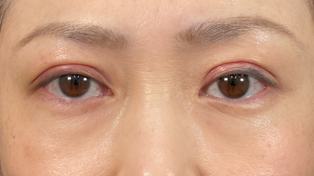 手術前の状態 その1