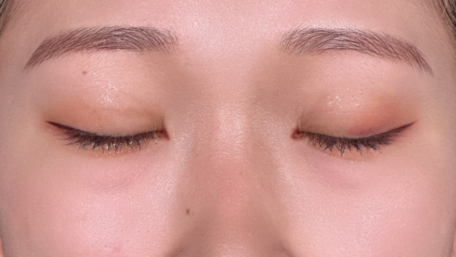 手術前の状態 その1