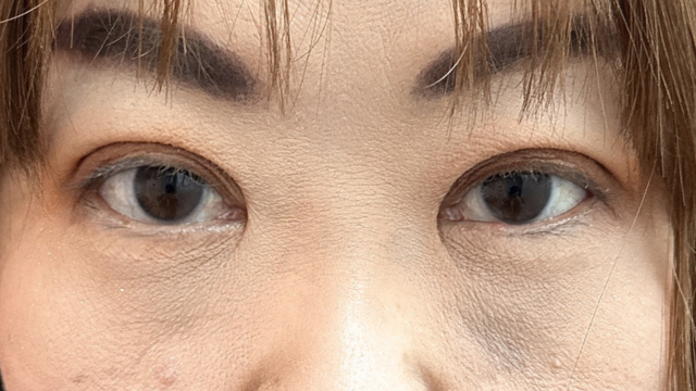 手术前的状态 其一