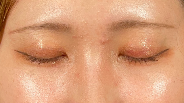 手术前的状态 其一