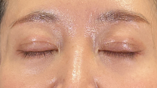 手術前の状態 その1