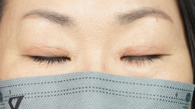 手術前の状態 その1