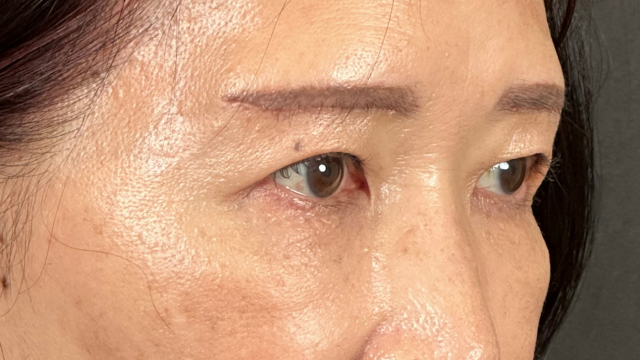 手術前の状態 その1