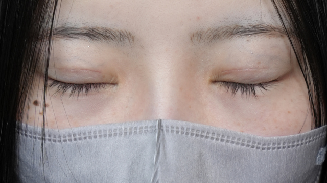 手術前の状態 その1