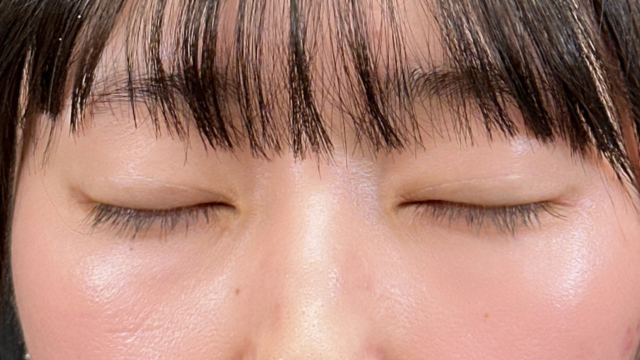 手術前の状態 その1