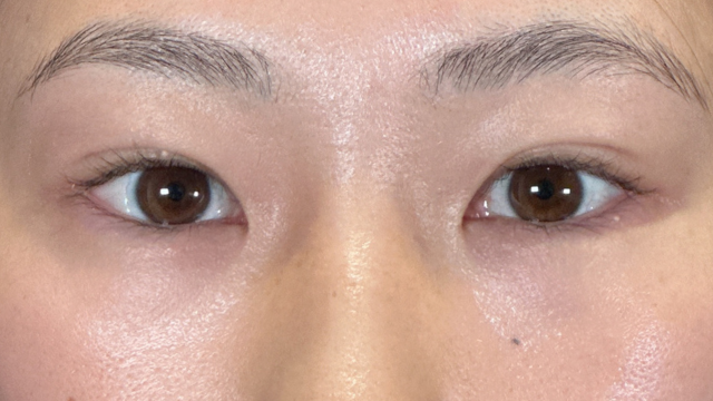 手術前の状態 その1