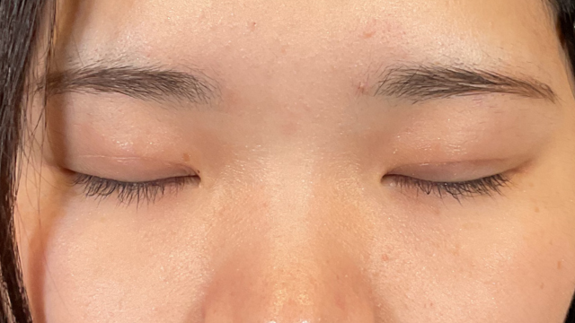 手術前の状態 その1