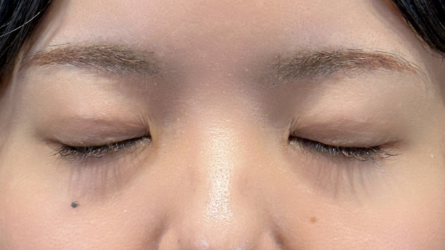 手術前の状態 その1