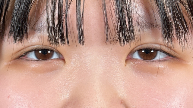 手术前的状态 其一