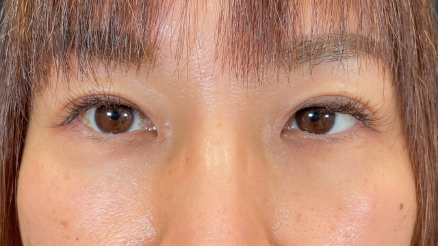 手术前的状态 其一