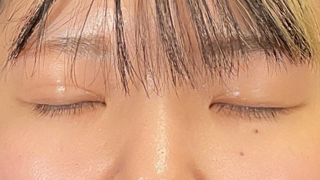 手术前的状态 其一