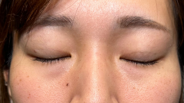 手術前の状態 その1