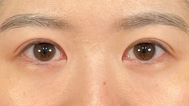 手術前の状態 その1