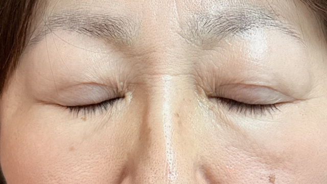 手术前的状态 其一