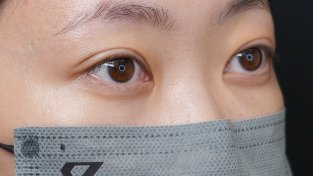 手術前の状態 その1