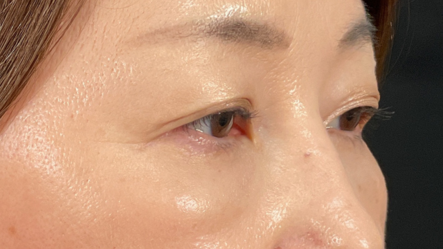 手术前的状态 其一