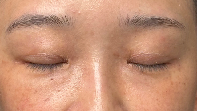 手术前的状态 其一