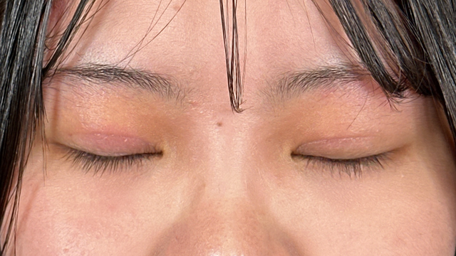 Postoperative Condition Part 1