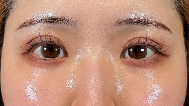 手術前の状態 その1