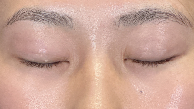 手術前の状態 その1