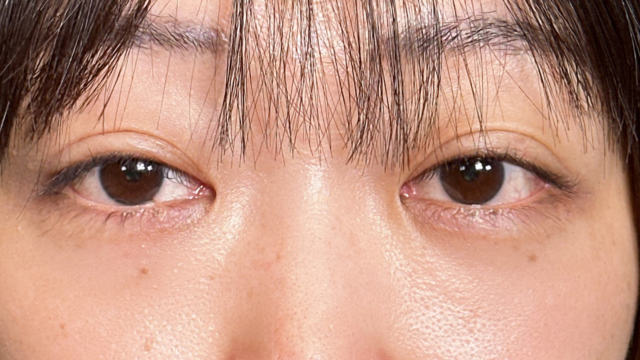 手術前の状態 その1