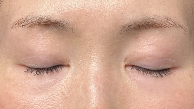 手術前の状態 その1