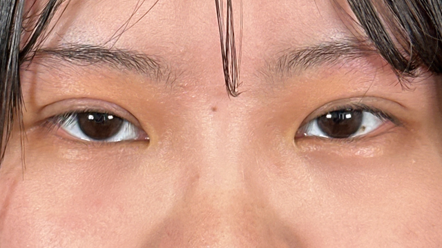 Postoperative Condition Part 1