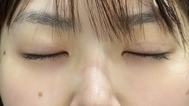 手术前的状态 其一