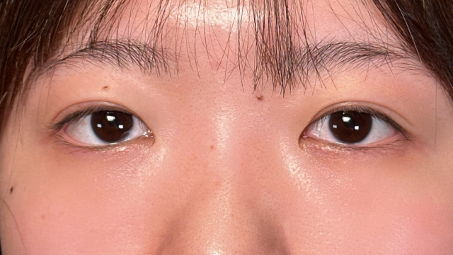 手术前的状态 其一