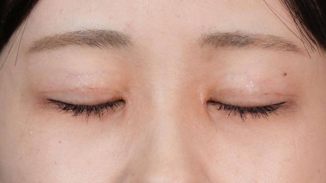 手術前の状態 その1