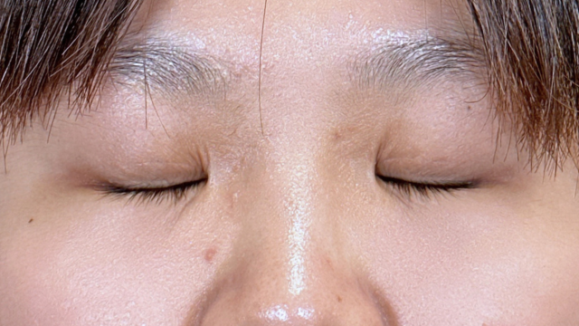 手术前的状态 其一