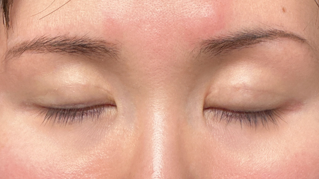 Postoperative Condition Part 1