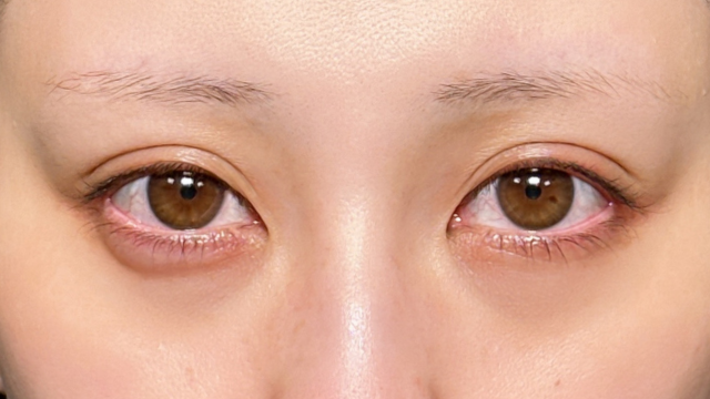 手术前的状态 其一