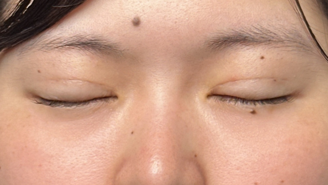 手术前的状态 其一