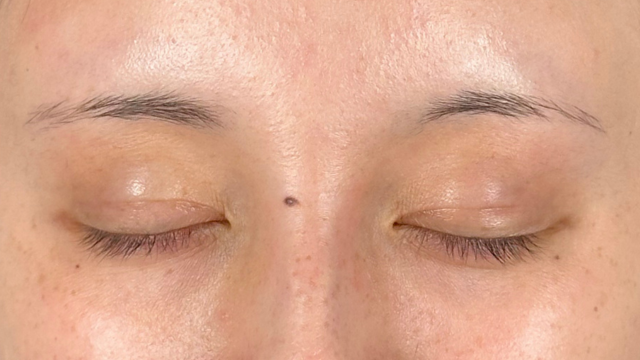 手术前的状态 其一