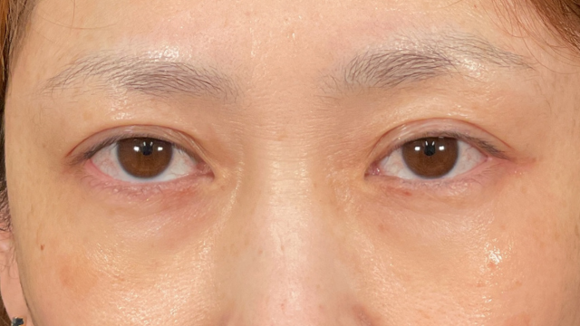 手術前の状態 その1