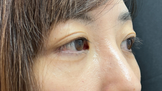 手术前的状态 其一