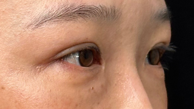 手术前的状态 其一