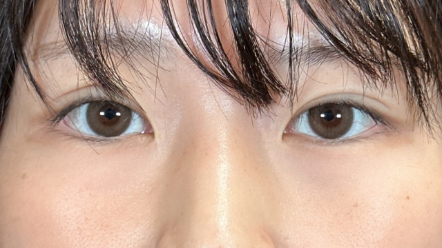 手術前の状態 その1