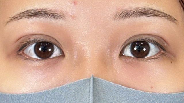 手術前の状態 その1