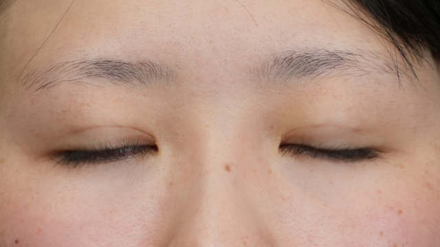 手术前的状态 其一