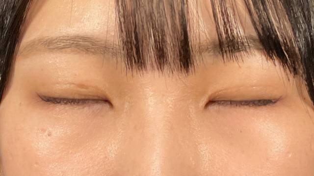 手術前の状態 その1