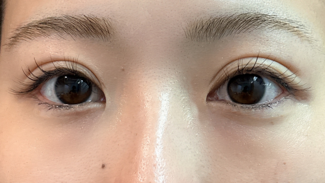 手術前の状態 その1