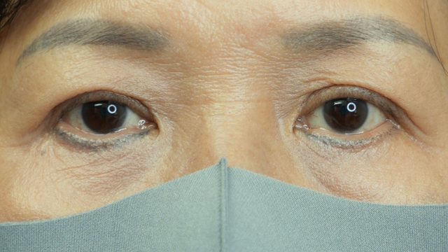 手术前的状态 其一