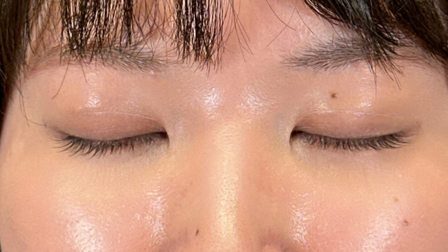 手術前の状態 その1