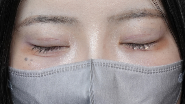 手術前の状態 その1