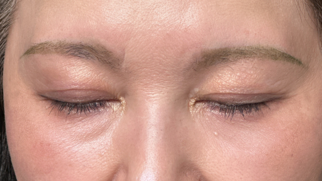 手术前的状态 其一