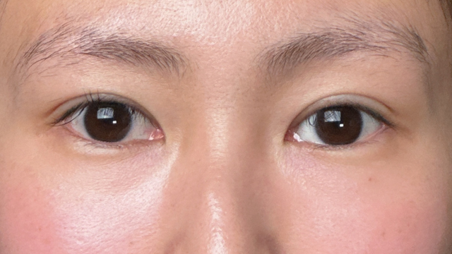 手術前の状態 その1